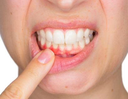 person pointing to bleeding gums